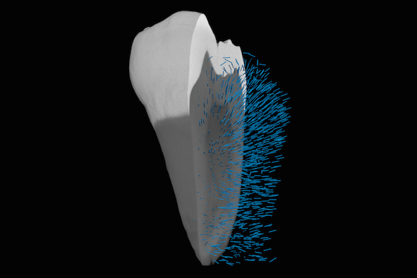 Roentgen Tensor Tomographie von einem Zahn