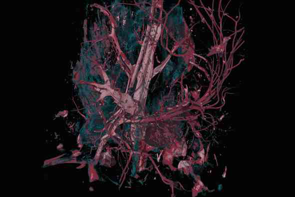 Staining of tumor tissue with X-ray contrast media for biomedical X-ray micro ct
